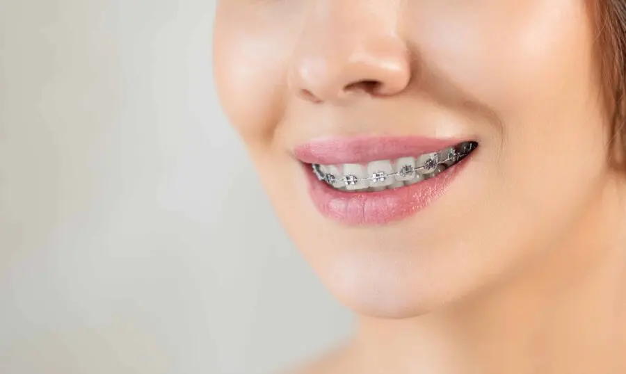 Transforming Smiles with Braces in Mesquite, TX: Smile City Orthodontics
