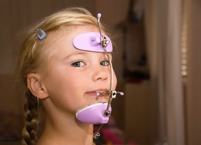 little girl wearing purple Reverse Pull Headgear Braces in Sunnyvale, tx