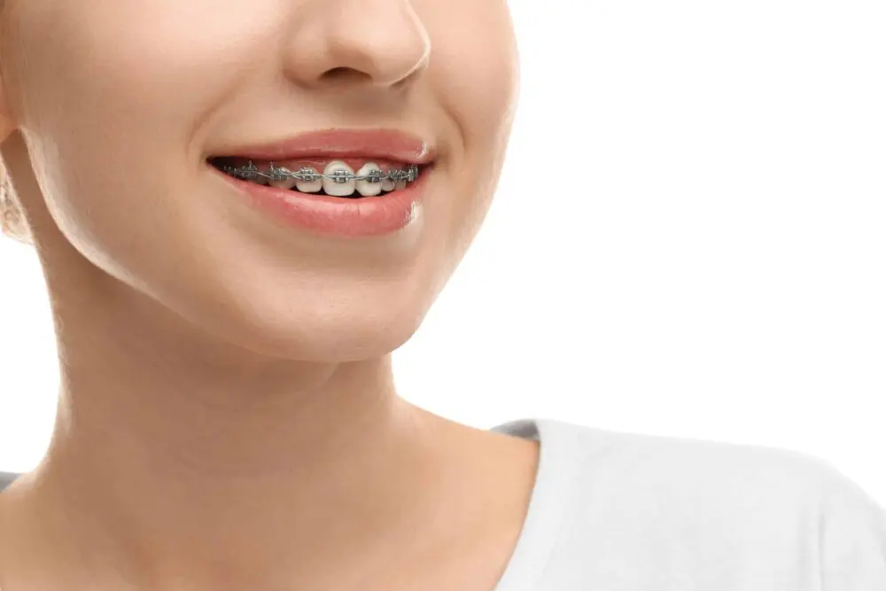 Braces in Dallas: Here’s What You Should Know