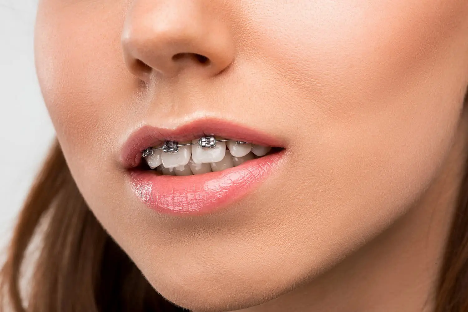 A close-up shows a woman's mouth with metal braces correcting an overbite at Smile City Orthodontics in Sunnyvale, TX; she has a neutral expression and soft makeup.