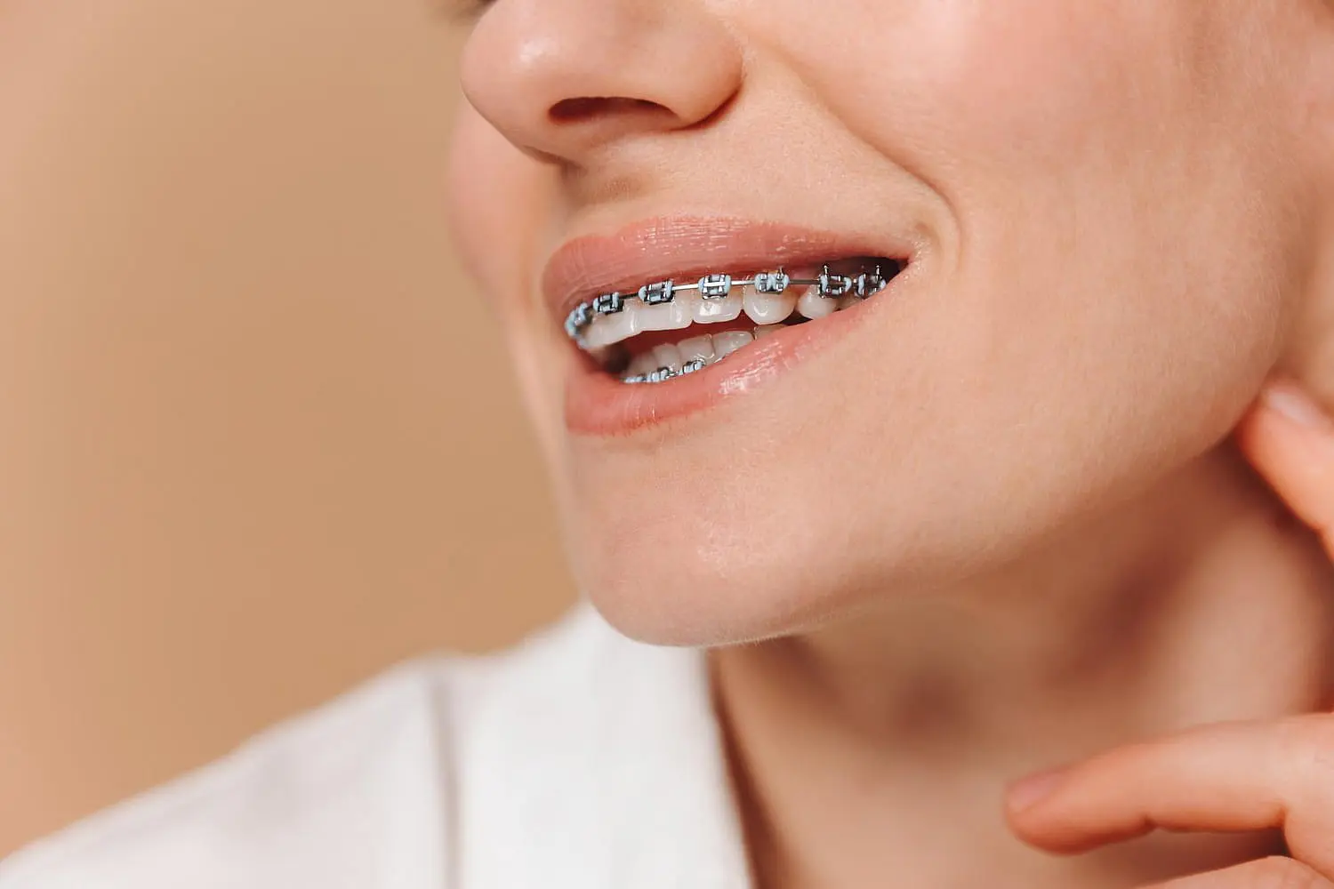 A person with metal braces correcting an overbite rests their hand near their chin, smiling at Smile City Orthodontics in Sunnyvale, TX.