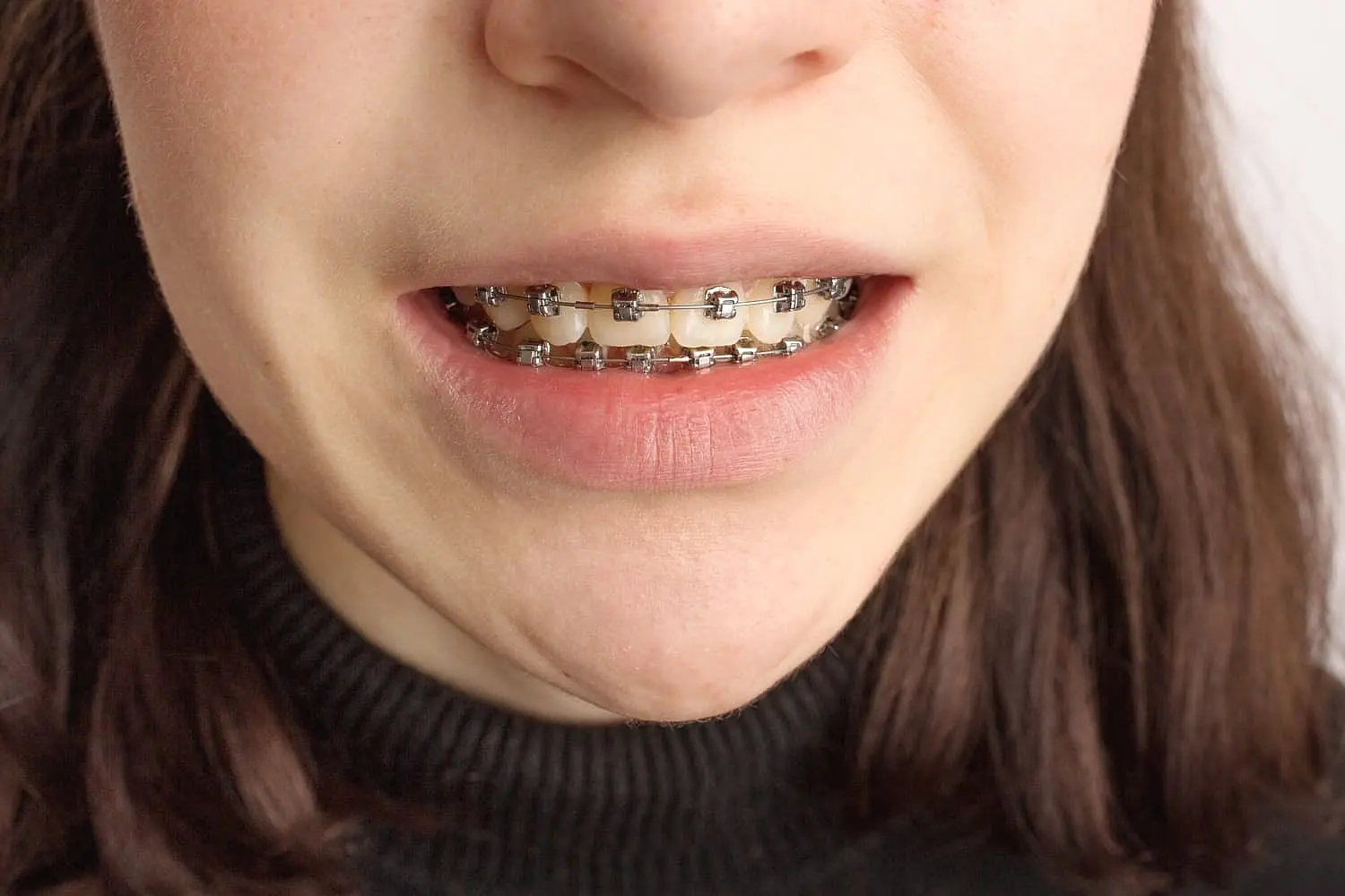 At Smile City Orthodontics in Sunnyvale TX, a close-up highlights an individual with fair skin and brown hair wearing metal braces on both upper and lower teeth to correct an overbite, dressed in a dark top.