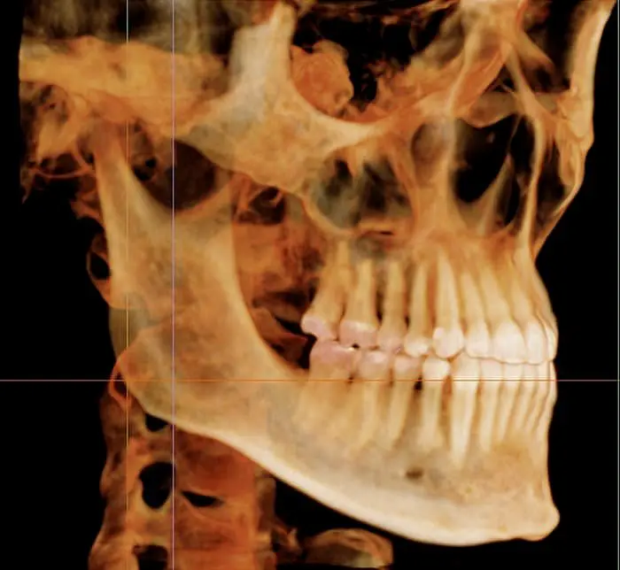 A 3D side view of a skull and jawbone showing teeth, with translucent orange areas at Smile City Orthodontics in Sunnyvale, TX.