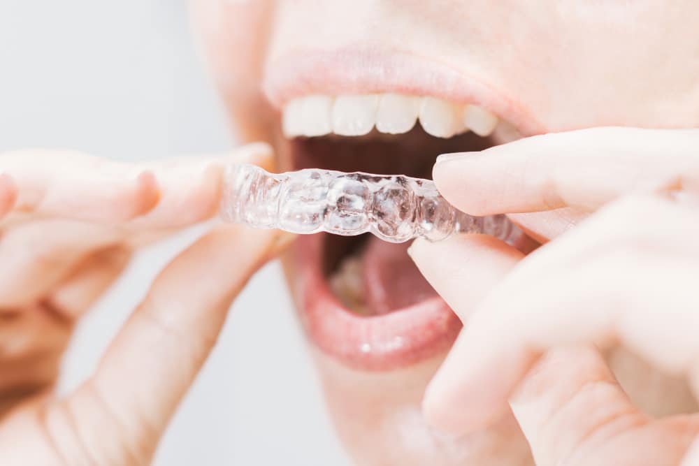 Clear Aligners [dm-citystate]