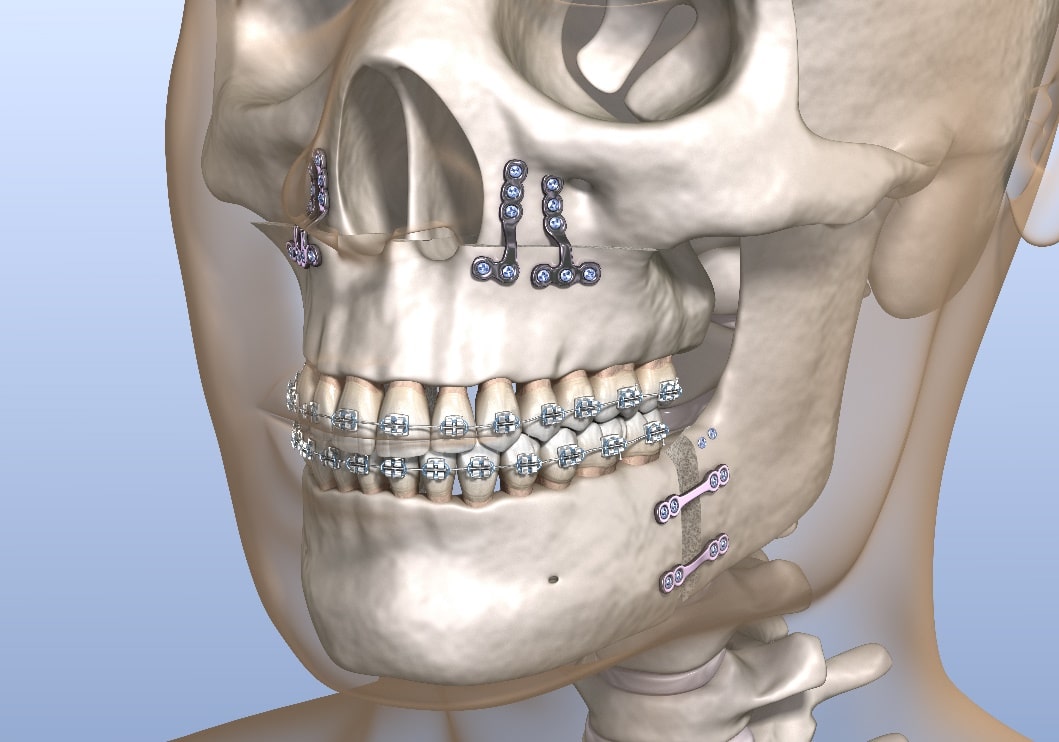 Surgical Orthodontics [dm-citystate]