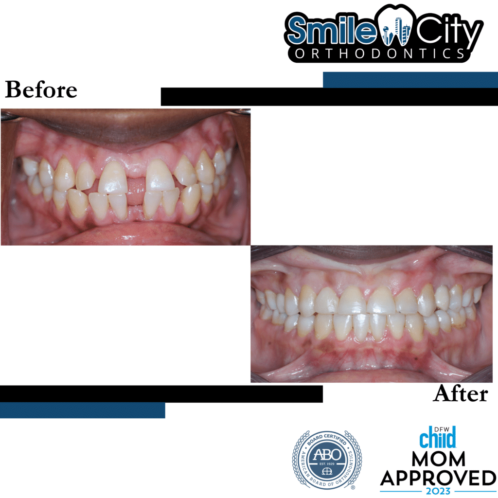 Smile Gallery | Smile City Orthodontics | Orthodontist in Sunnyvale, TX ...