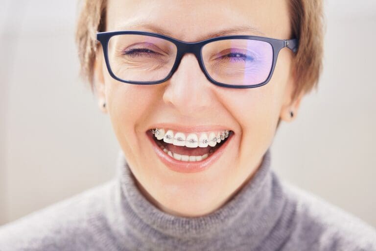 Sunnyvale Braces for Adults