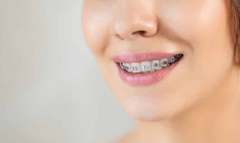 Braces Mesquite
