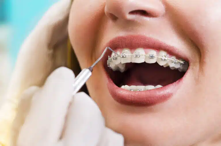 Alternatives to Braces Sunnyvale
