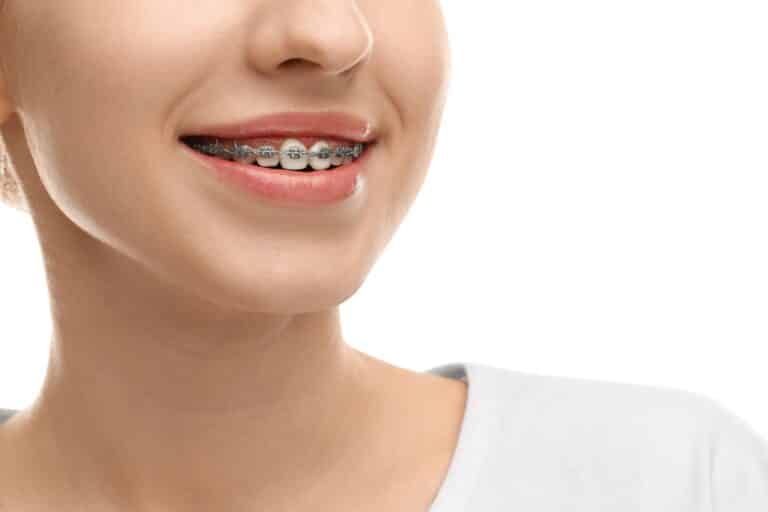 Braces in Dallas