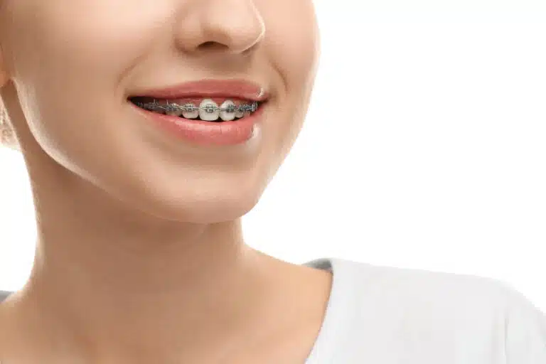 Braces in Dallas