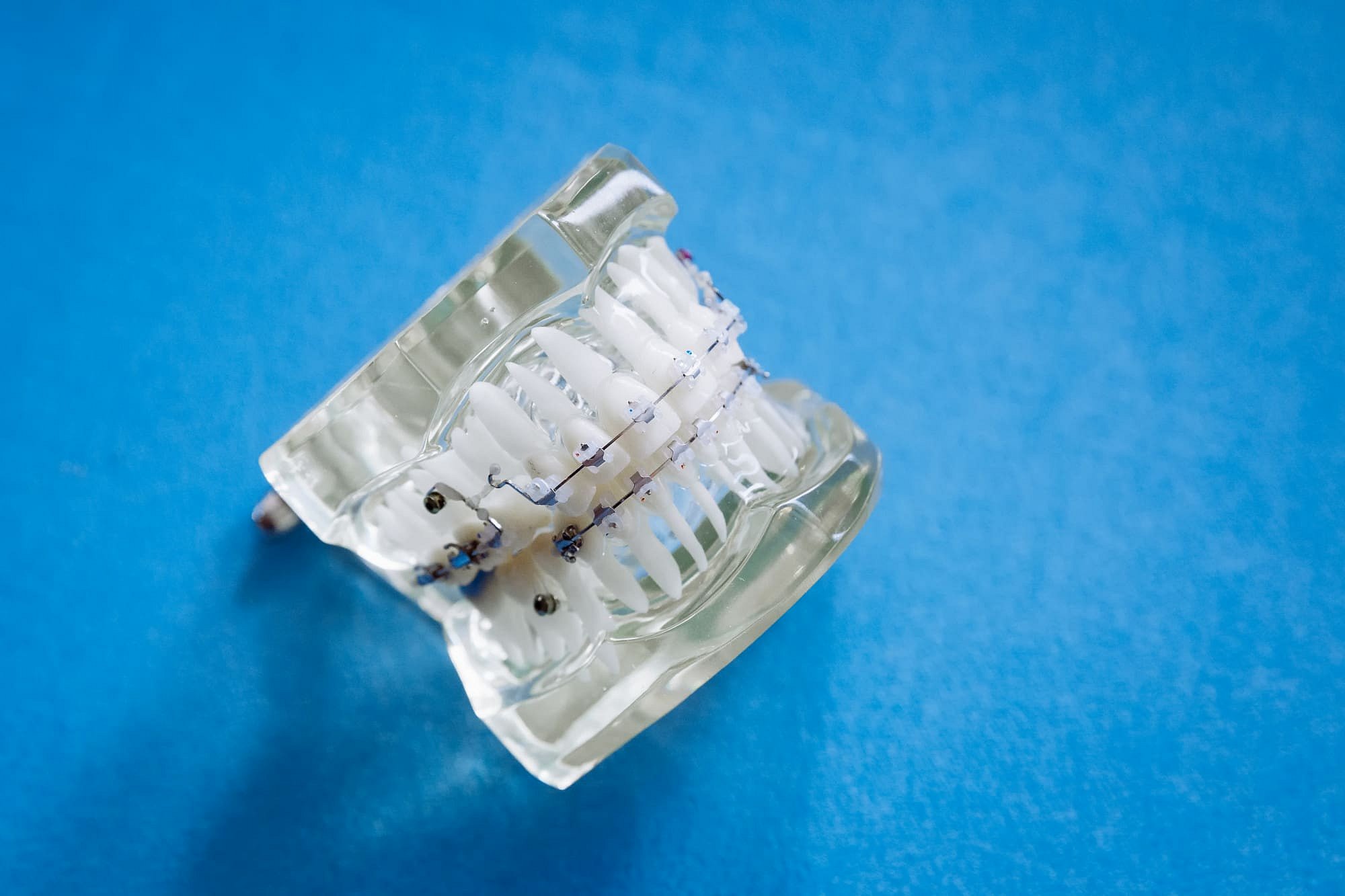 A clear dental model with metal braces is displayed on a blue background at Smile City Orthodontics in Sunnyvale TX, showcasing local orthodontic treatment options.