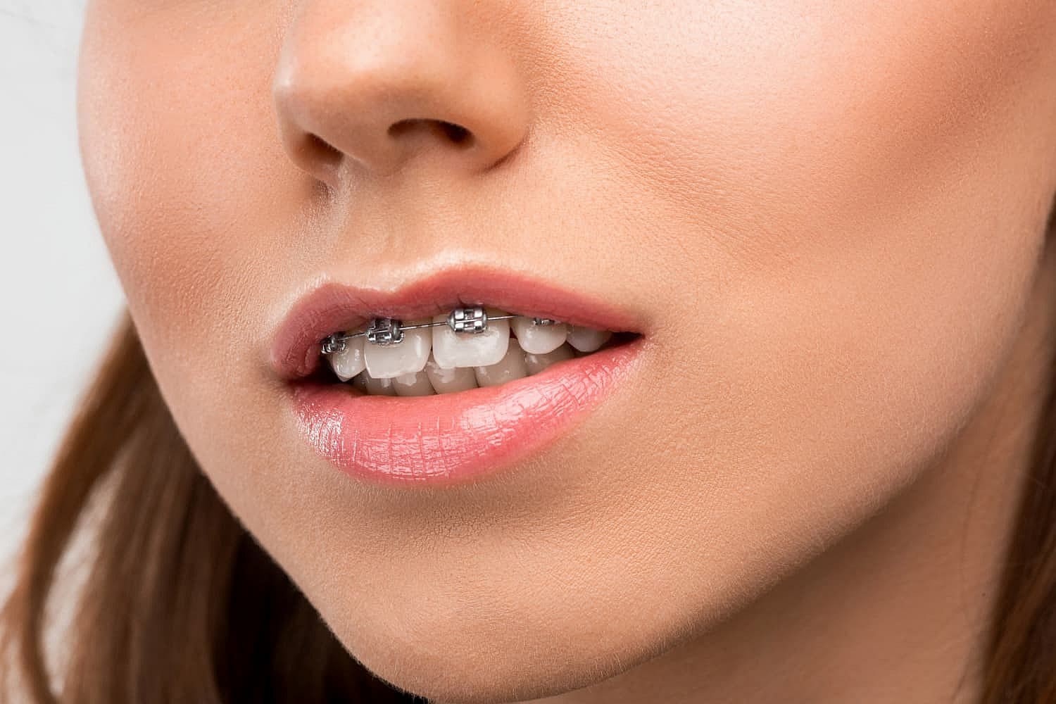A close-up shows a woman's mouth with metal braces correcting an overbite at Smile City Orthodontics in Sunnyvale, TX; she has a neutral expression and soft makeup.