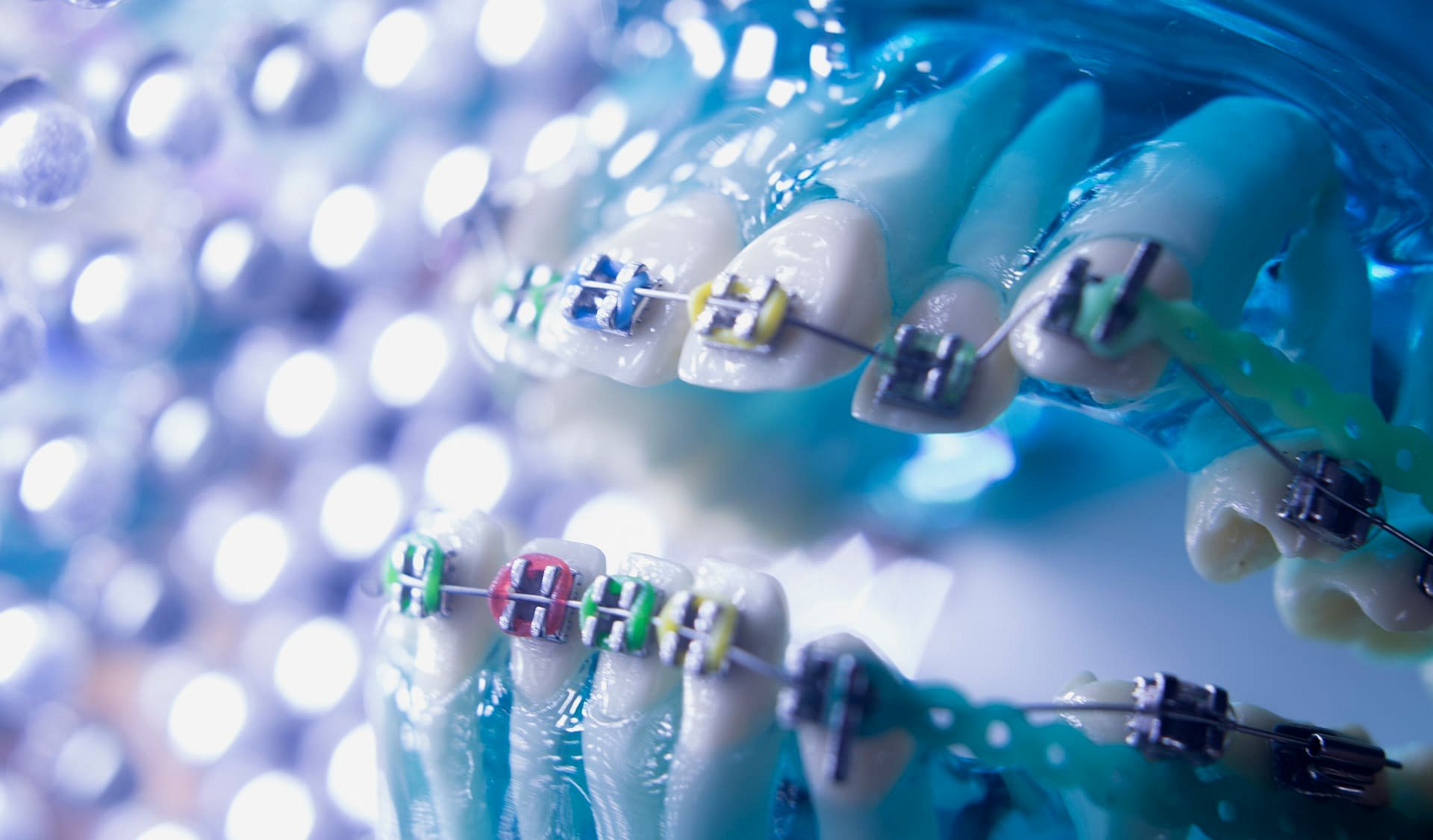At Smile City Orthodontics in Sunnyvale TX, a dental model with metal braces is closely examined as gloved hands adjust the orthodontic brackets.