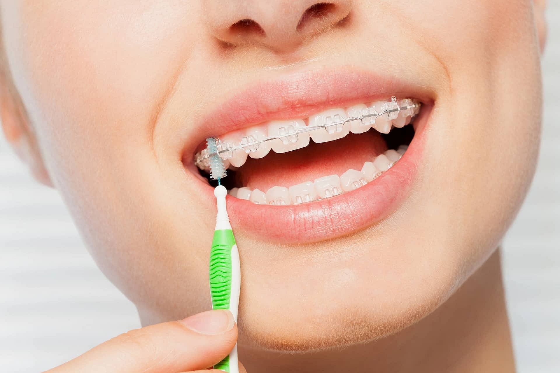 At Smile City Orthodontics in Sunnyvale TX, a person uses an interdental brush to clean clear braces and maintain a bright, healthy smile.
