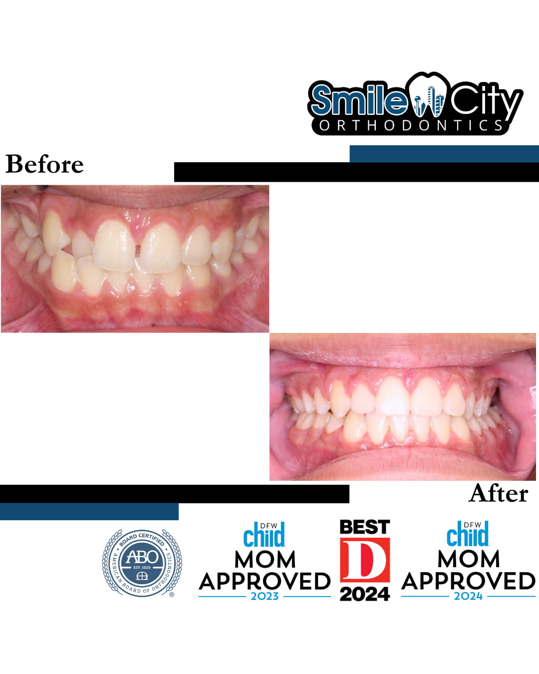 See before and after photos of teeth alignment improvement with Invisalign treatment at Smile City Orthodontics in Sunnyvale TX, featuring award and certification logos at the bottom.