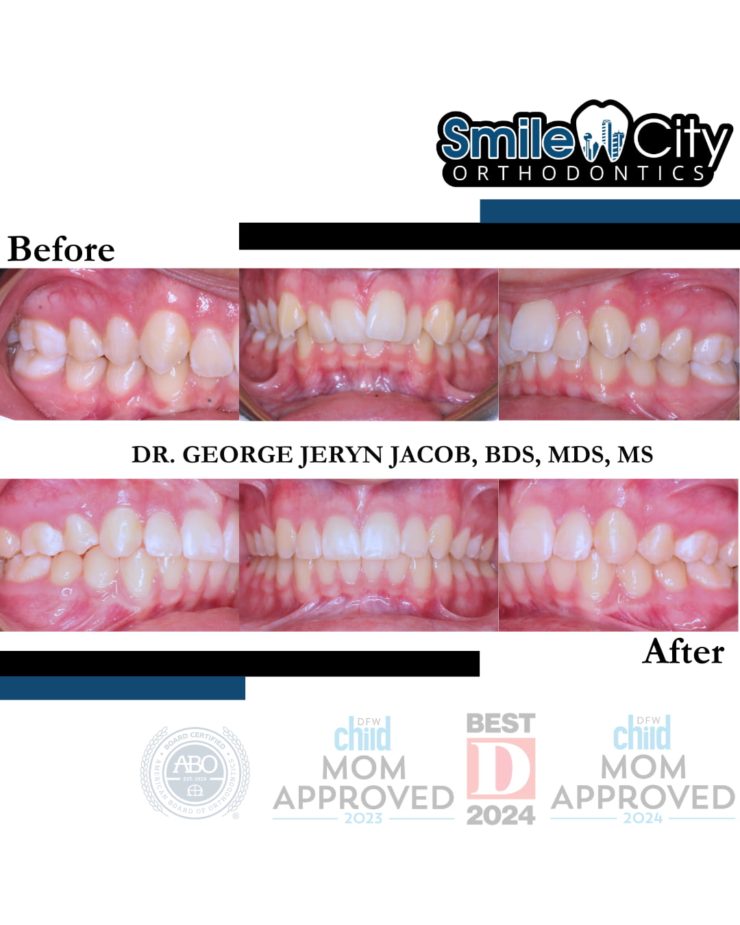 In Sunnyvale, TX, Smile City Orthodontics presents before and after Invisalign images that highlight dental alignment improvements, featuring the clinic's logo and doctor's name.