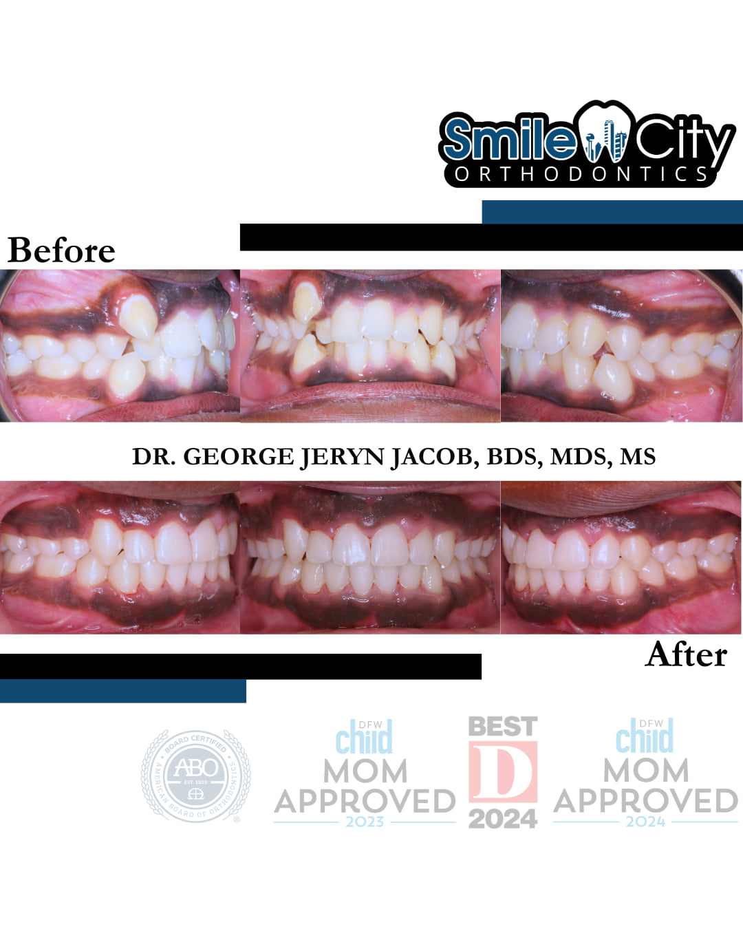 Before and after braces images highlight dental alignment improvements achieved by Smile City Orthodontics in Sunnyvale, TX.