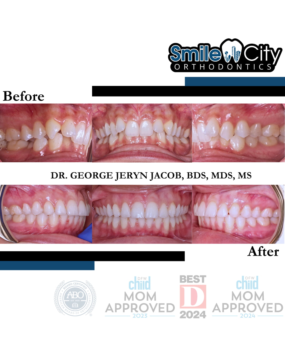 View before-and-after photos highlighting dental alignment improvement with Invisalign at Smile City Orthodontics in Sunnyvale TX, featuring logos and credentials of Dr. George Jeryn Jacob.