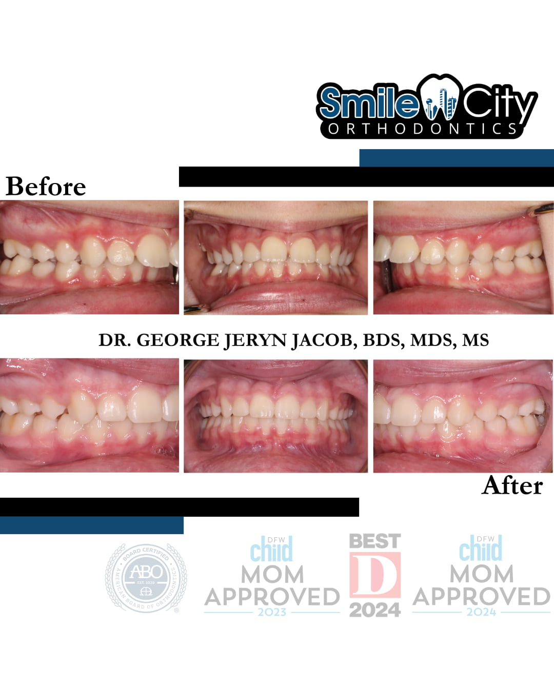 Before and after braces images at Smile City Orthodontics in Sunnyvale, TX highlight the dental alignment improvements achieved through orthodontic treatment.
