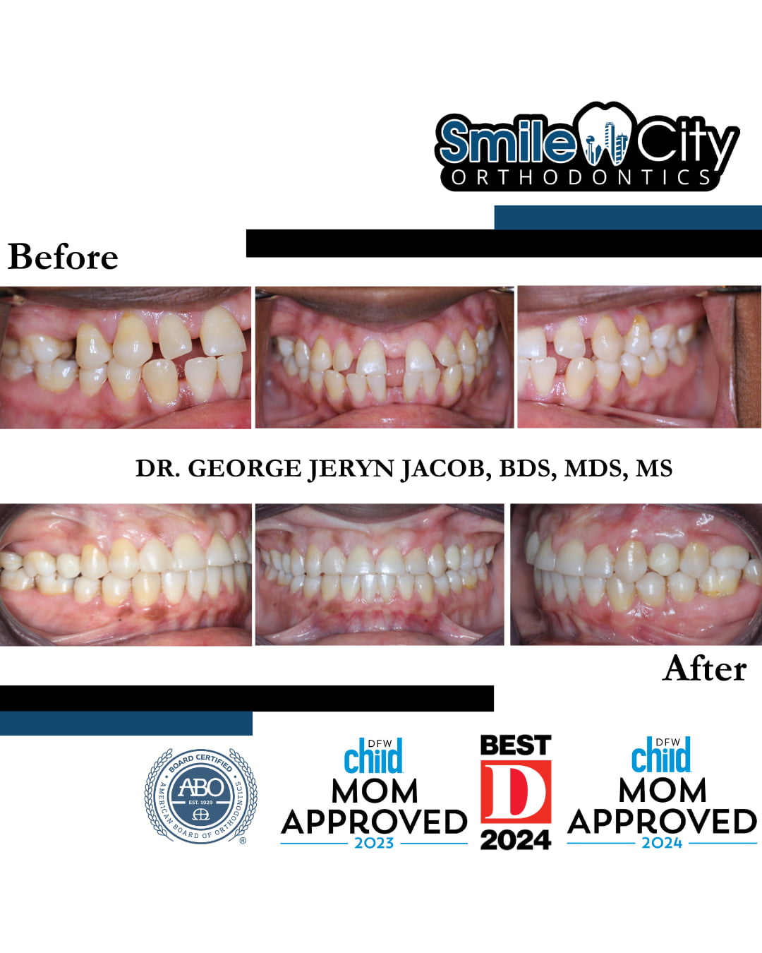 Showcasing dental alignment improvements through Before and After Braces photos, Smile City Orthodontics in Sunnyvale, TX features its branding and multiple award logos at the bottom.