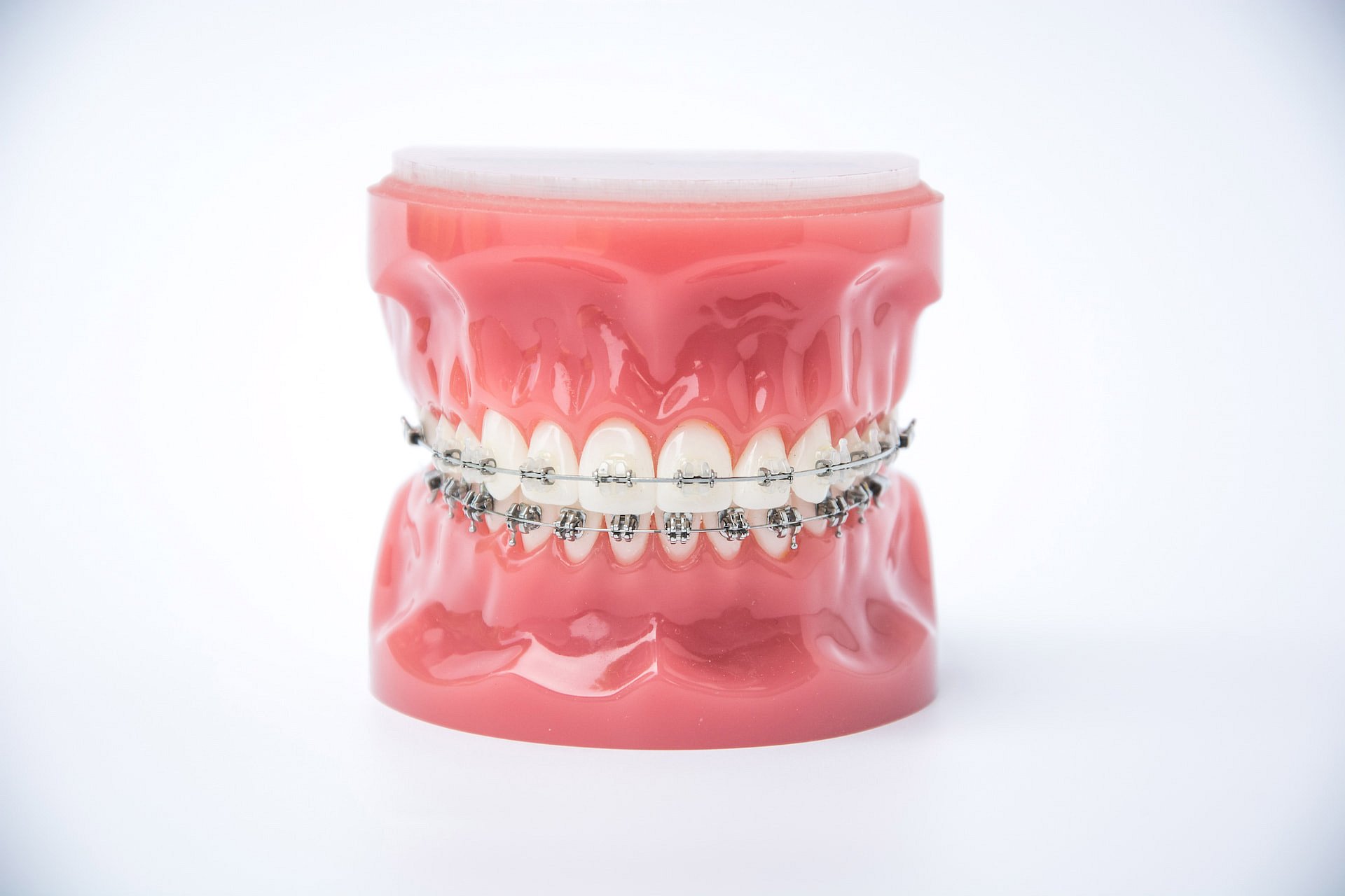 A dental model with metal braces on both upper and lower teeth is displayed against a plain background, showcasing the orthodontic solutions offered by Smile City Orthodontics in Sunnyvale, TX.