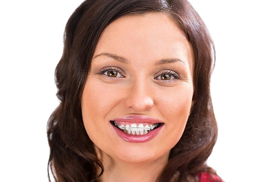A woman with long brown hair smiles, displaying ceramic braces on her teeth against a white background—an ideal representation of ceramic braces available at Smile City Orthodontics in Sunnyvale, TX.