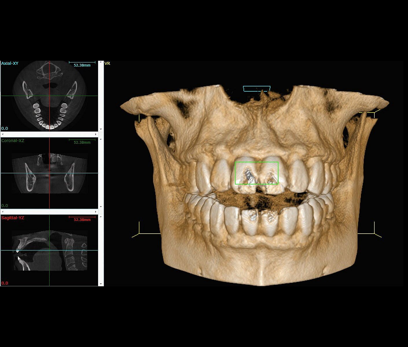 At Smile City Orthodontics in Sunnyvale, TX, a 3D dental CT scan displays a frontal view of the upper and lower jaw alongside cross-sectional images on the left.