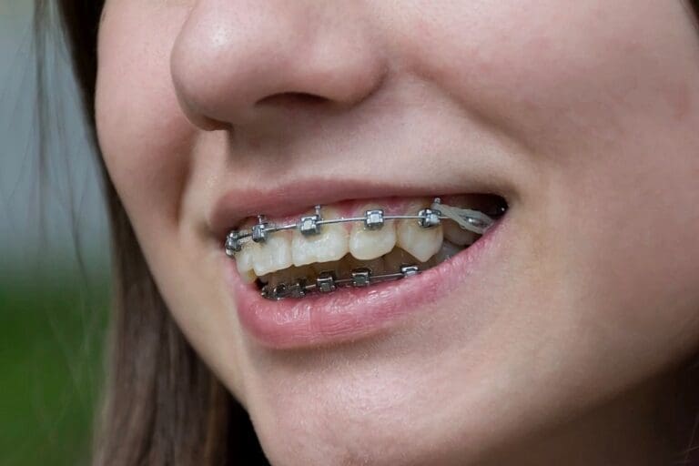 Close-up of a smiling patient showing metal braces on teeth – braces for overbite in sunnyvale, tx.