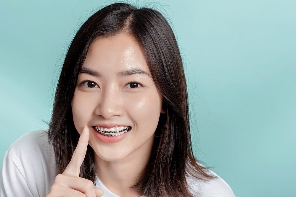 How Long Do Braces Take in Sunnyvale, TX