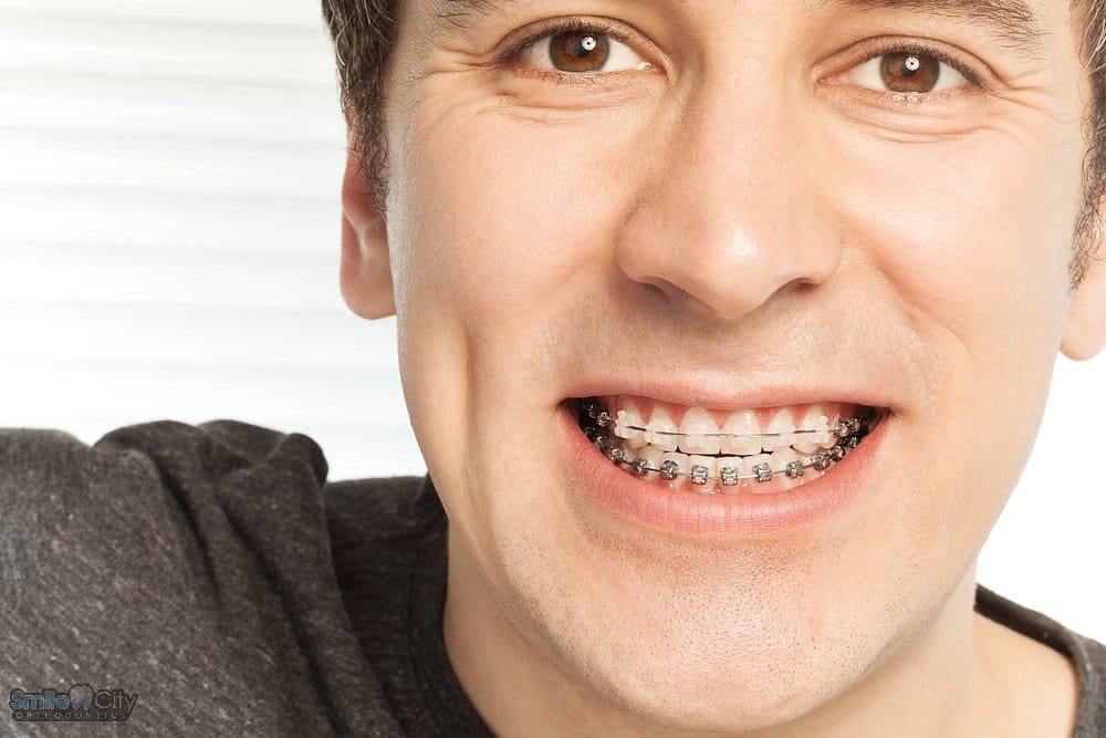 happy young man with metal braces - Overbite vs Underbite in Sunnyvale, TX