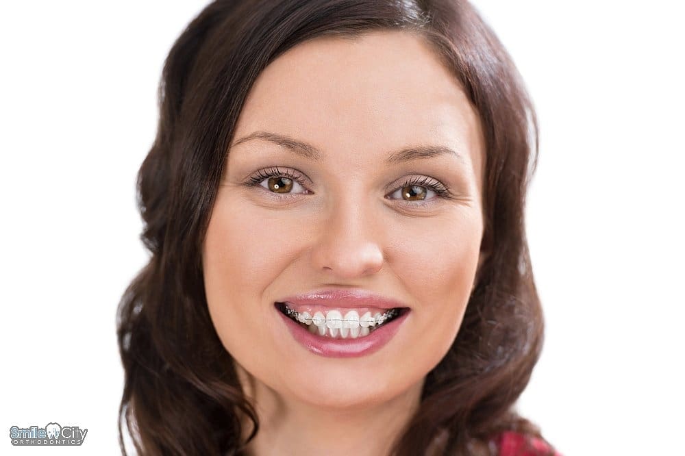 woman wearing orthodontic ceramic clear bracecs - overbite vs underbite in Sunnyvale, TX.