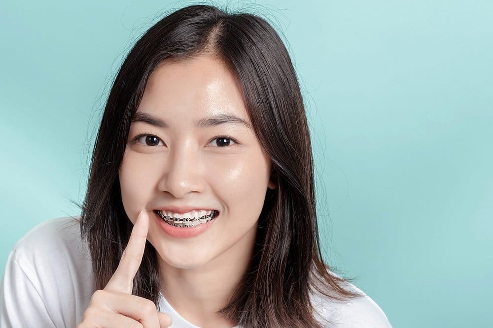 How to Get Braces Glue Off Teeth in Sunnyvale, TX
