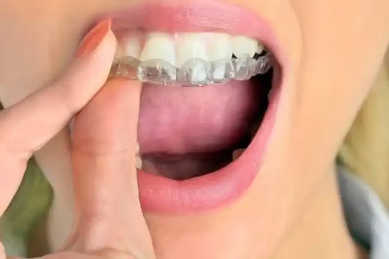 Does Invisalign Hurt